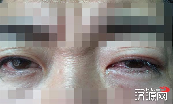 花千元文美瞳线 麻醉药滴眼里致眼角膜受损 -